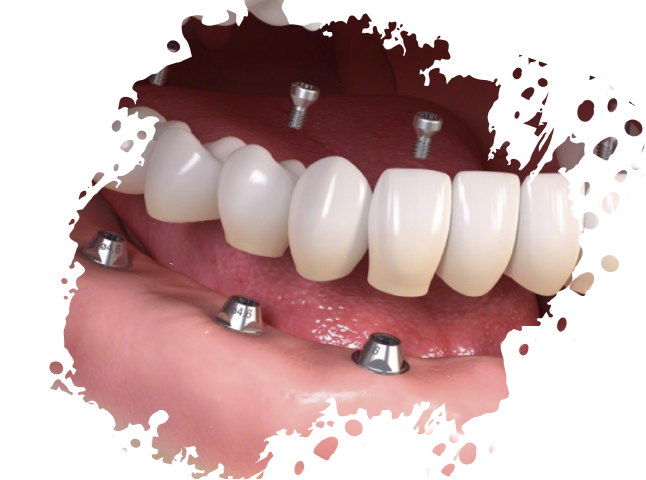 https://www.medicapro.com.tn/wp-content/uploads/2022/05/Implant-dentaire.png