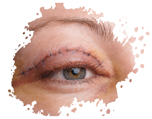 https://www.medicapro.com.tn/wp-content/uploads/2022/08/BLÉPHAROPLASTIE-image.jpg